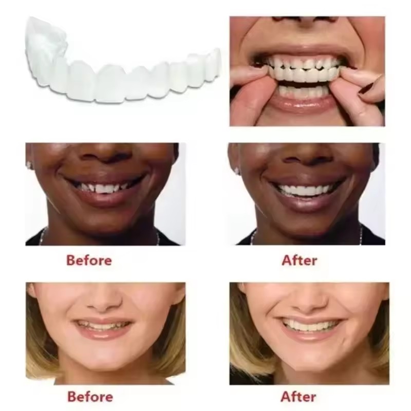 Veneer Gigi Pemutih Gigi Tirua - Teeth Whitening Session ulasan dan harga