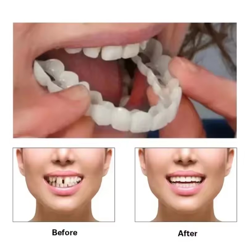 Veneer Gigi Pemutih Gigi Tirua - Teeth Whitening Session ulasan dan harga
