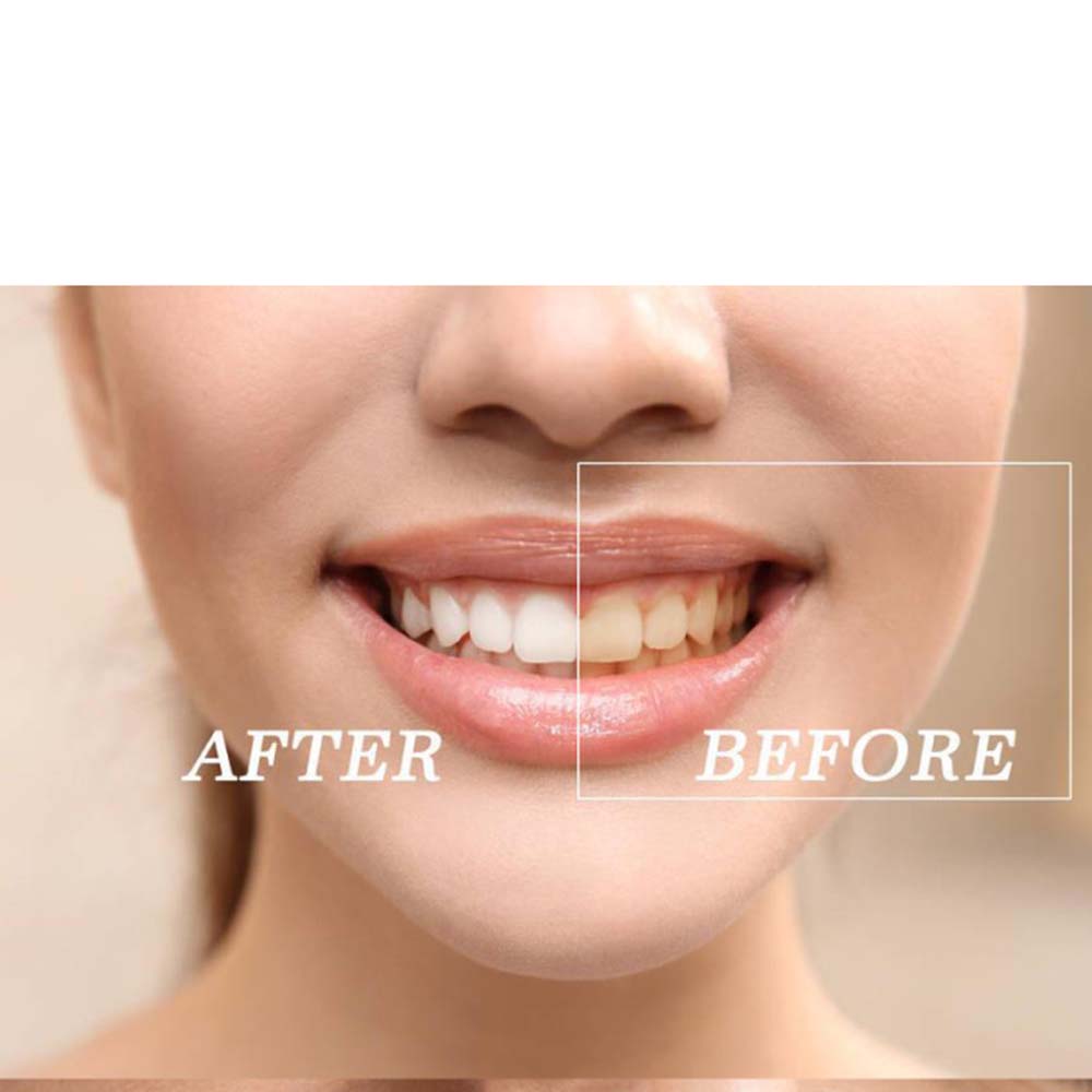 Kit Gel pemutih gigi peroksida - Teeth Whitening Bleach ulasan dan harga